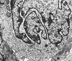 F, 37y. | mycosis fungoides … cerebriform nucleus of Sézary cell F, 37y. | mycosis fungoides … cerebriform nucleus of Sézary cell